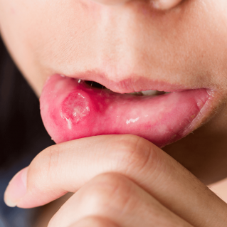 Comment enlever un aphte naturellement ?